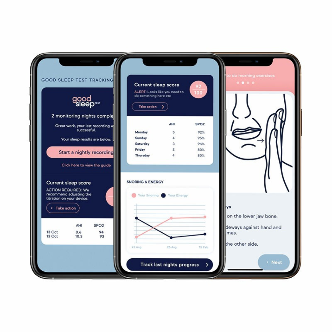 Hushd Avera Mandibular Advancement Splint (MAS)